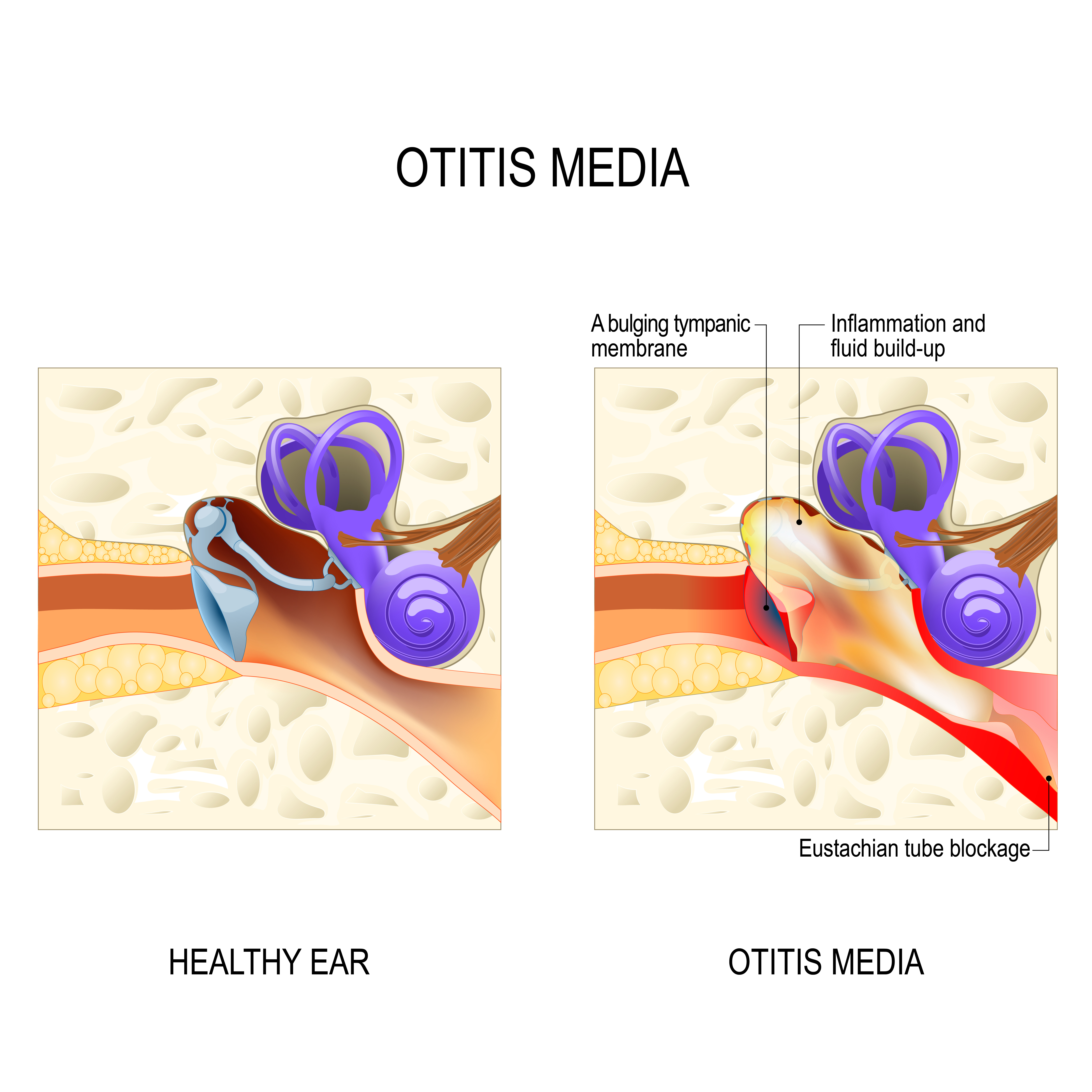 Illustration comparing a healthy ear to one with otitis media, a condition causing inflammation and fluid buildup in the middle ear | Source: Getty Images