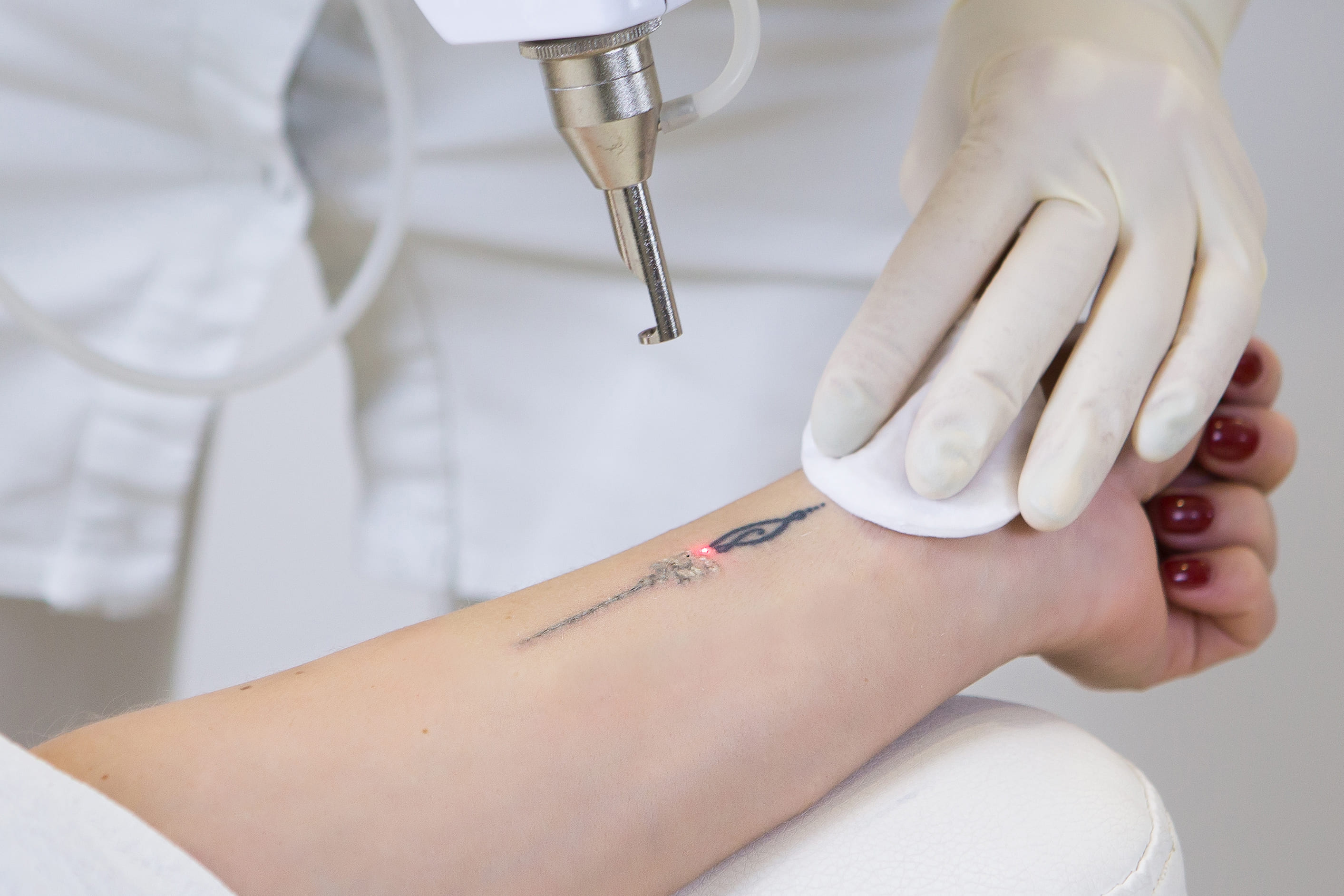 Tatto Removal | Shutterstock