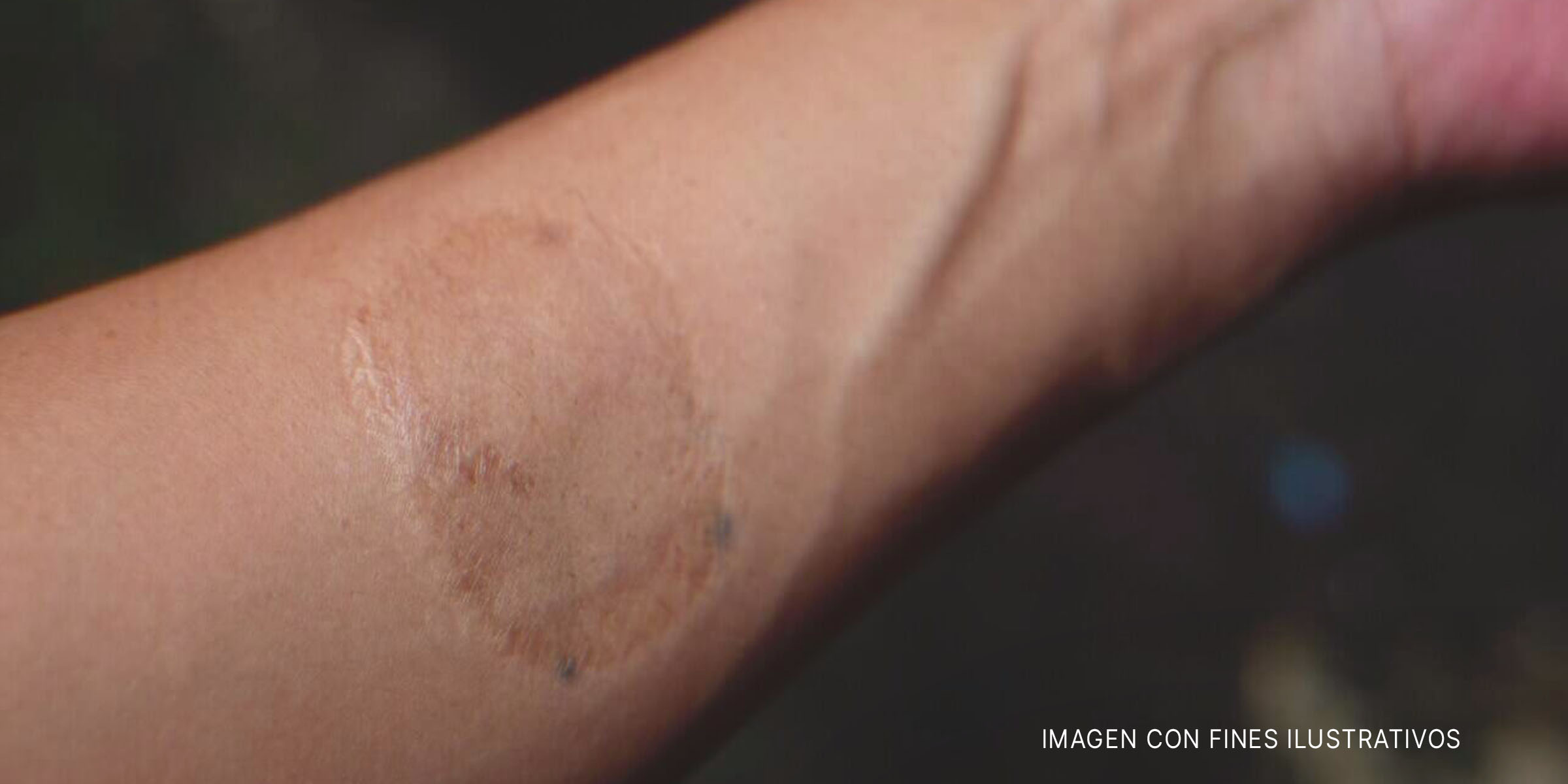 Cicatriz en un brazo. | Foto: Shutterstock
