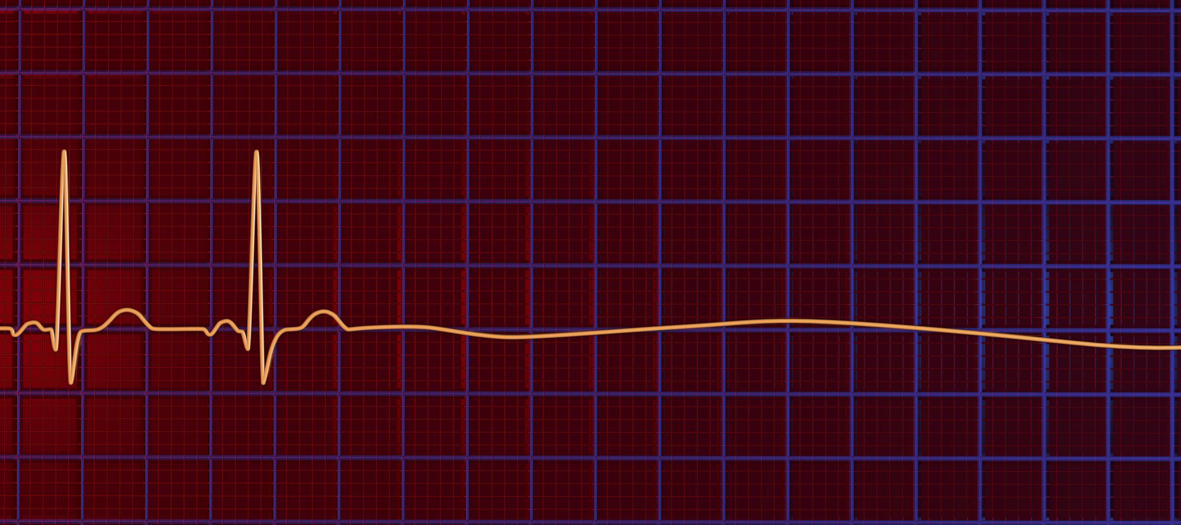 Illustration of an ECG flatline, indicating cardiac arrest due to asystole | Source: Getty Images