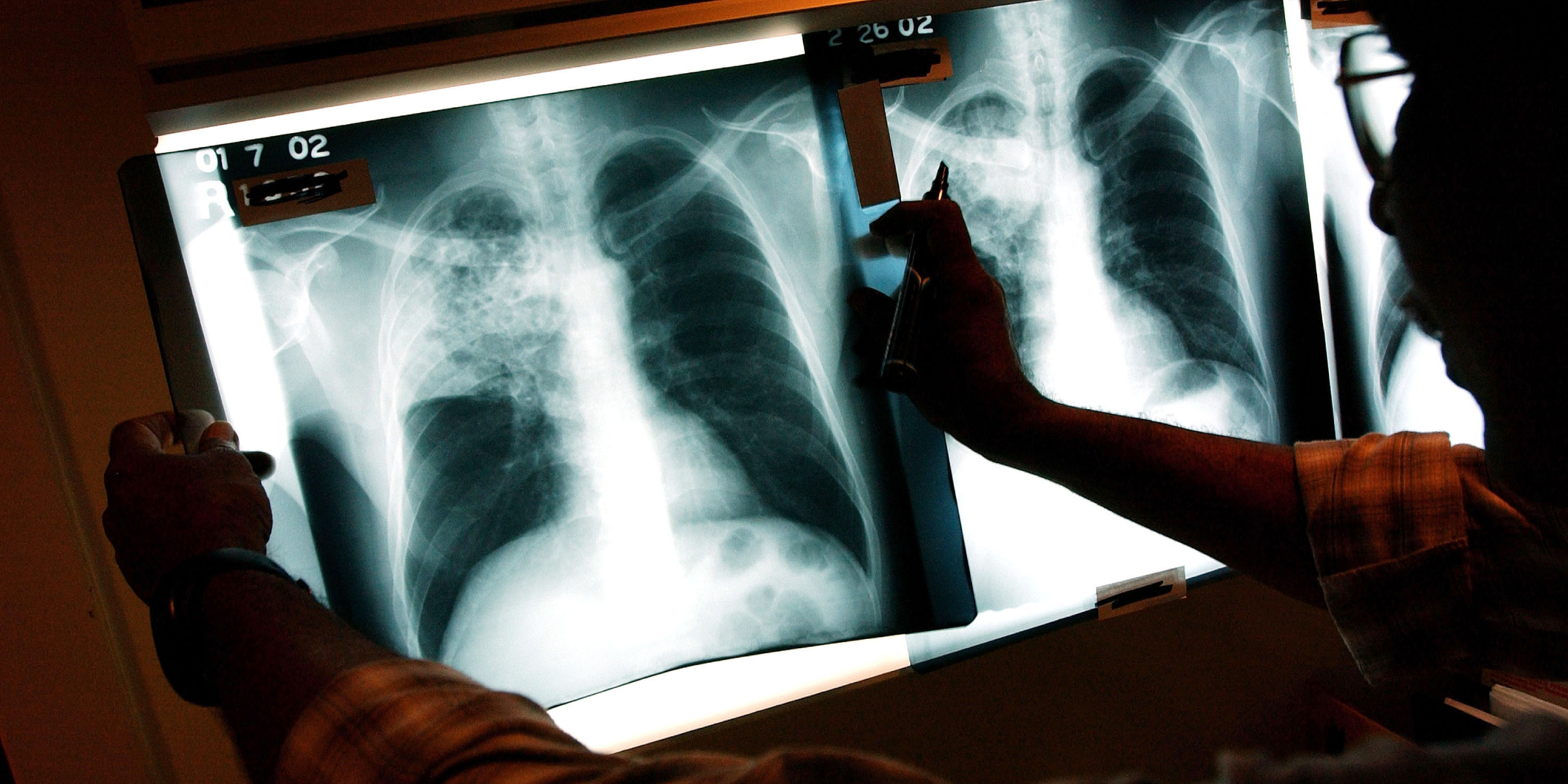 A doctor reviews a tuberculosis (TB) patient's x-rays | Source: Getty Images