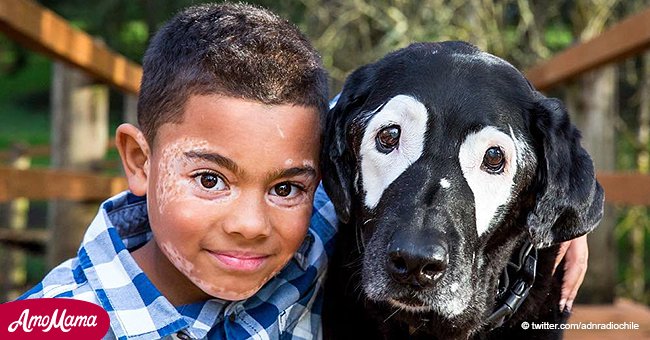 Ein Hund half einem kleinen Jungen mit Vitiligo, sich in dem Spiegel anzusehen und sich normal zu fühlen