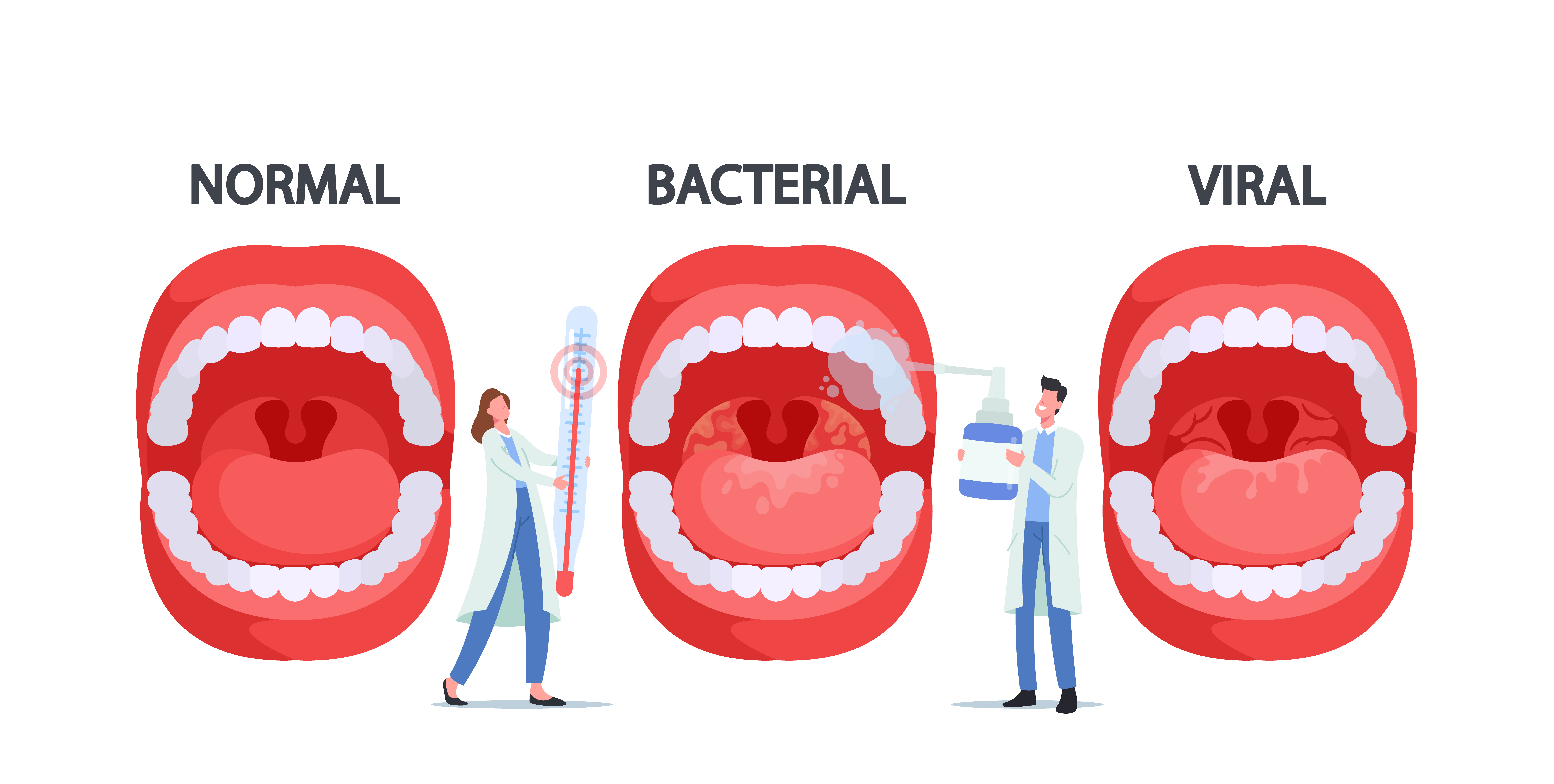 Vector illustration showing Tonsil Streptococcus Thermophilus bacteria infection | Source: Getty images