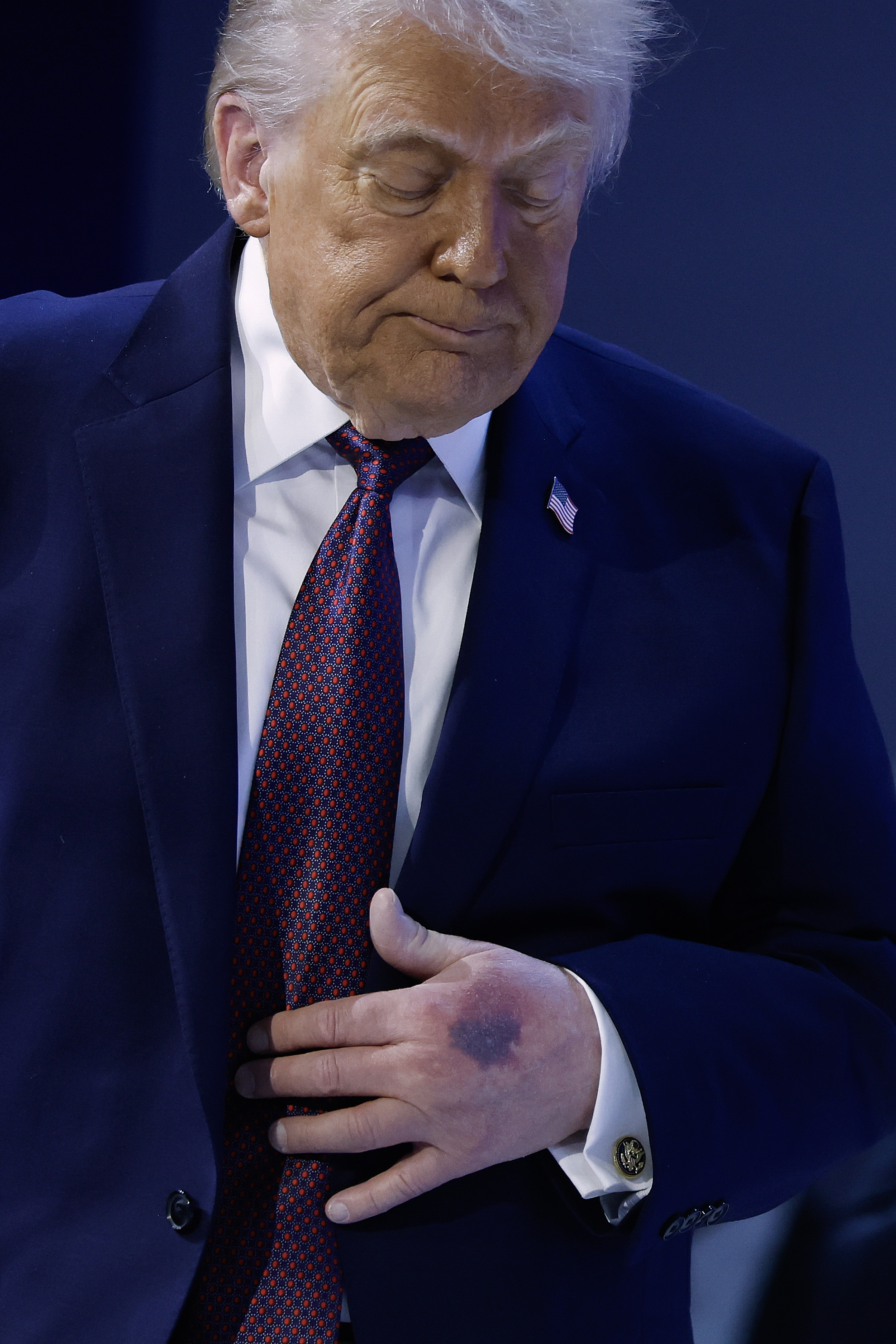 A bruise can be seen on the back of Donald Trump's left hand during a signing ceremony for the “Board of Peace” at the World Economic Forum (WEF) on January 22, 2026 in Davos, Switzerland | Source: Getty Images