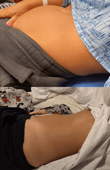 Kayley Reese's before and after surgery photos | Photo: Tiktok.com/thesavvykay