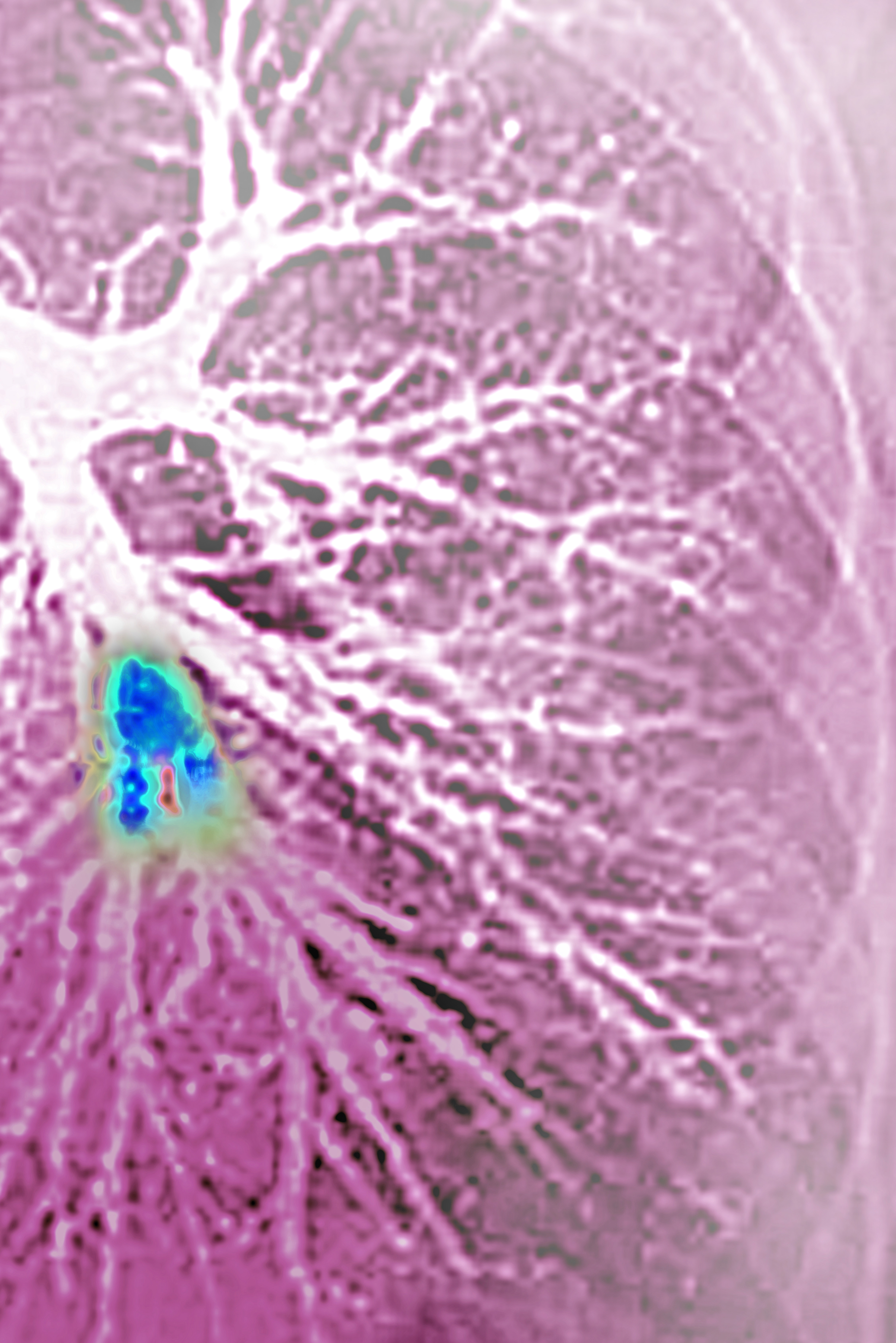 Pulmonary embolism in the left lower lobe (pulmonary artery blocked by a blood clot). | Source: Getty Images