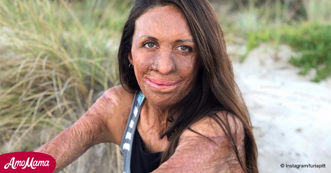 'I am different, not disfigured': the inspiring story of Turia Pitt