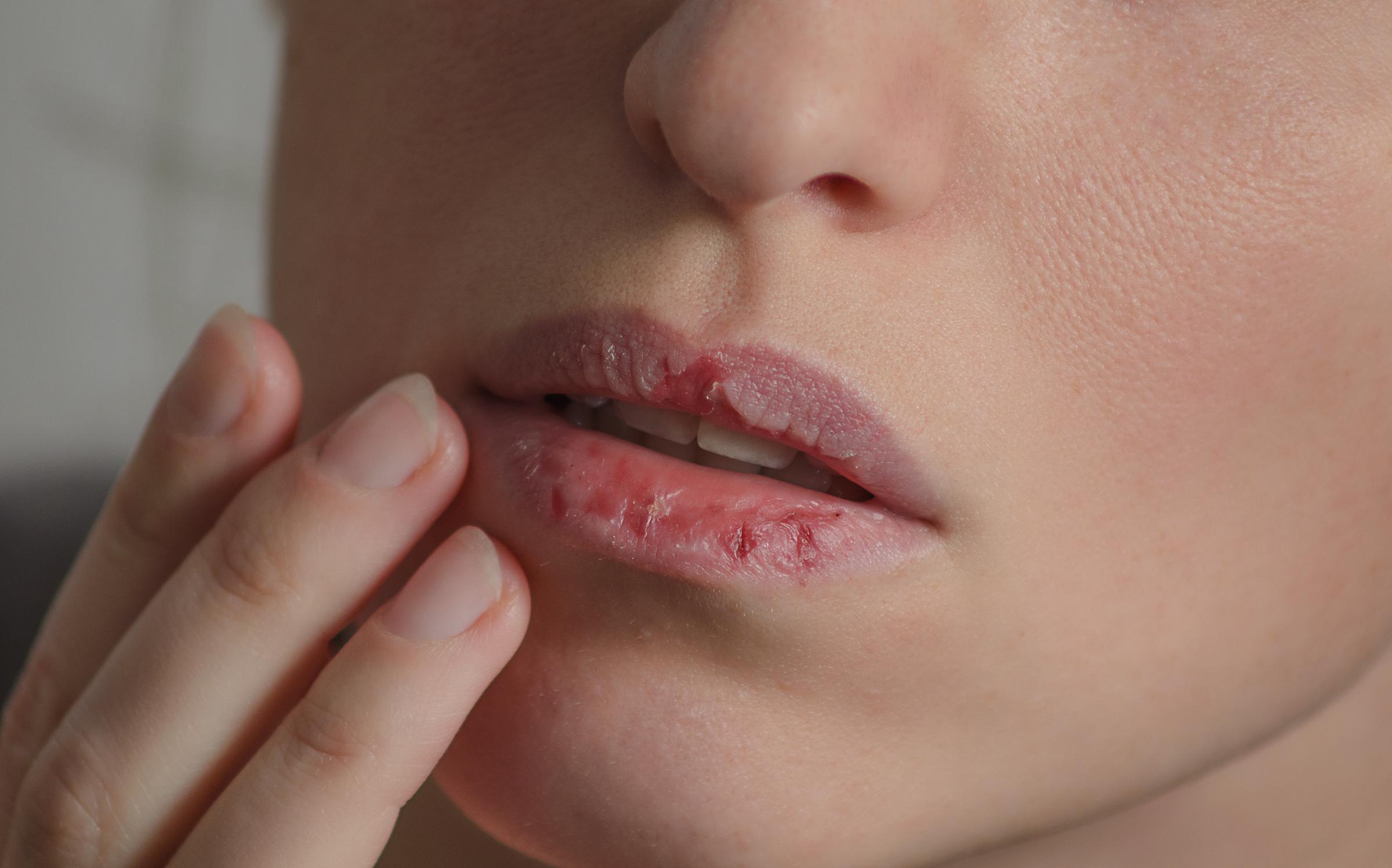 A woman with chapped lips | Source: Getty Images