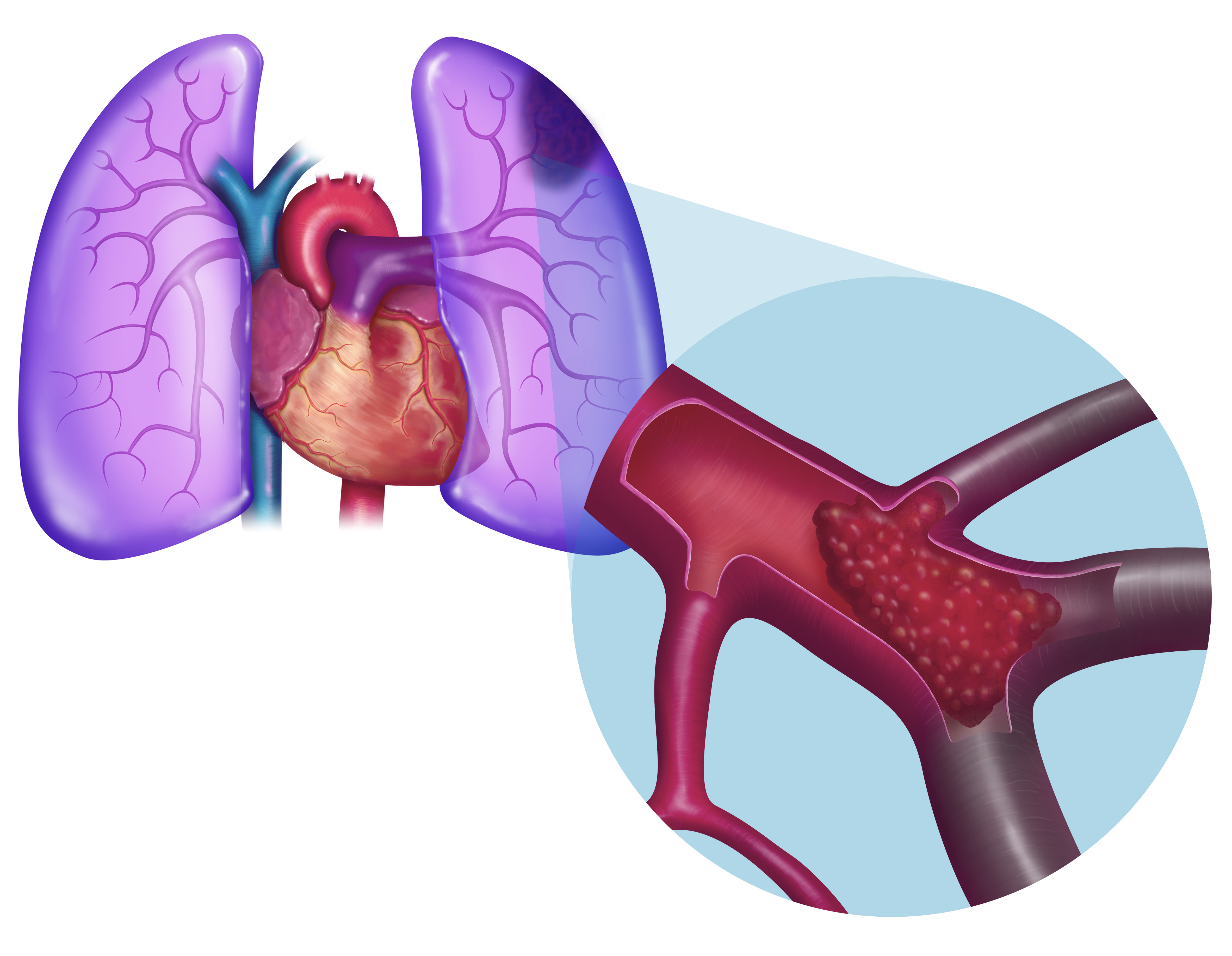 An illustration showing how a blood clot travels to the lungs through the heart, eventually blocking small pulmonary arterioles and causing a pulmonary embolism. | Source: Getty Images