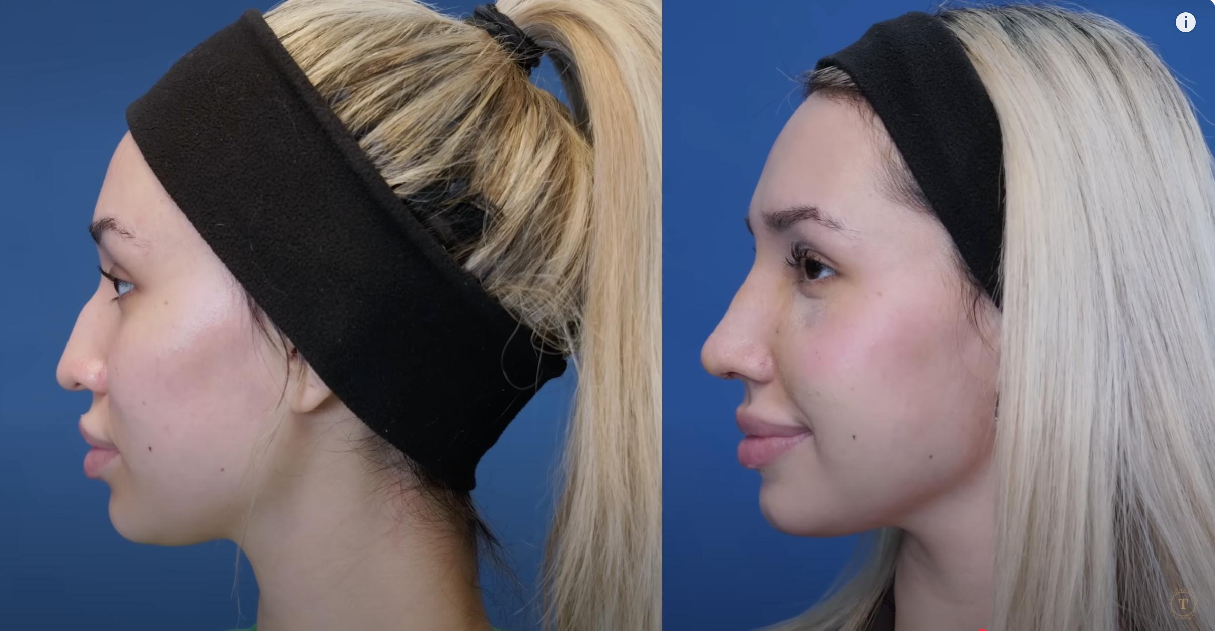 Ivana before and after surgery dated July 26, 2024 | Source: YouTube/@Dr.Truesdale
