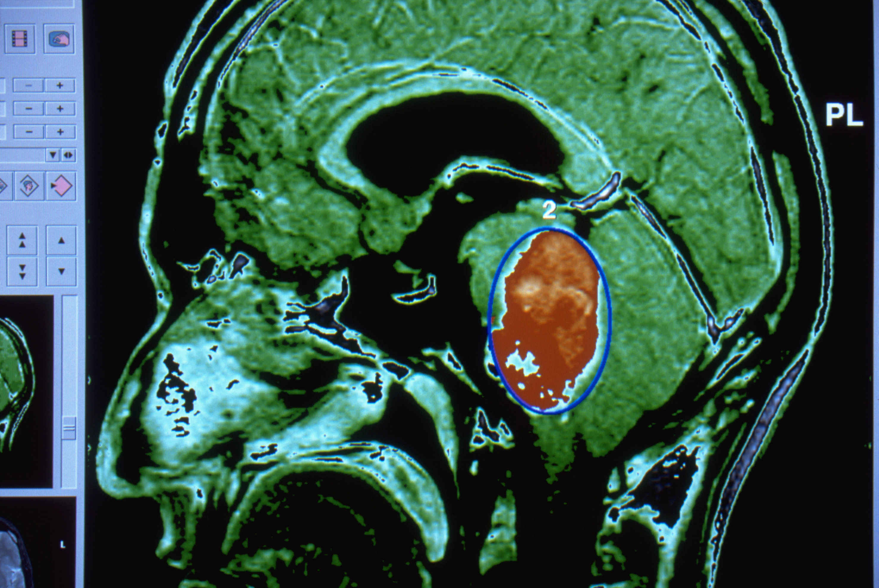 A head MRI showing a large tumor, marked in orange | Source: Getty Images