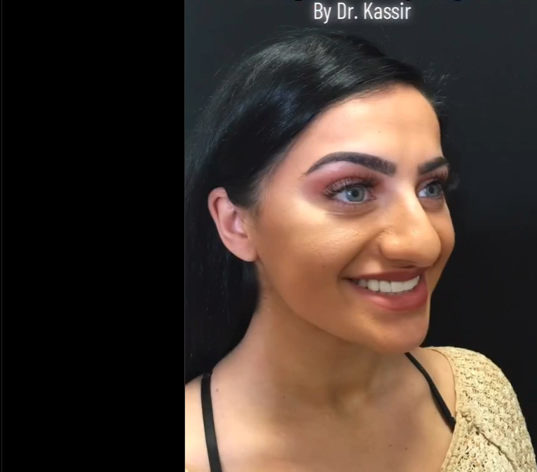 Amanda Haddad before rhinoplasty, dated December 13, 2022 | Source: Instagram/drkassir