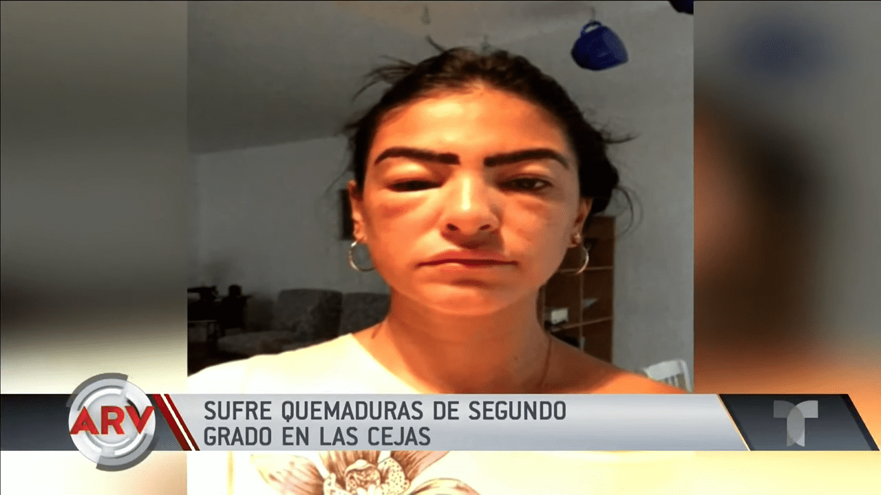 Las consecuencias de tratamiento en el rostro de Liz │Imagen tomada de: YouTube / Al Rojo Vivo