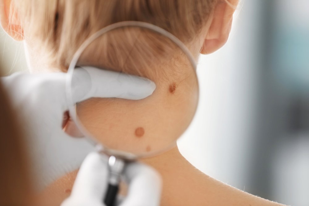 Dermatologue examine la tache de naissance d'une patient. Photo : Shutterstock Dermatologue examine la tache de naissance d'une patient. Photo : Shutterstock