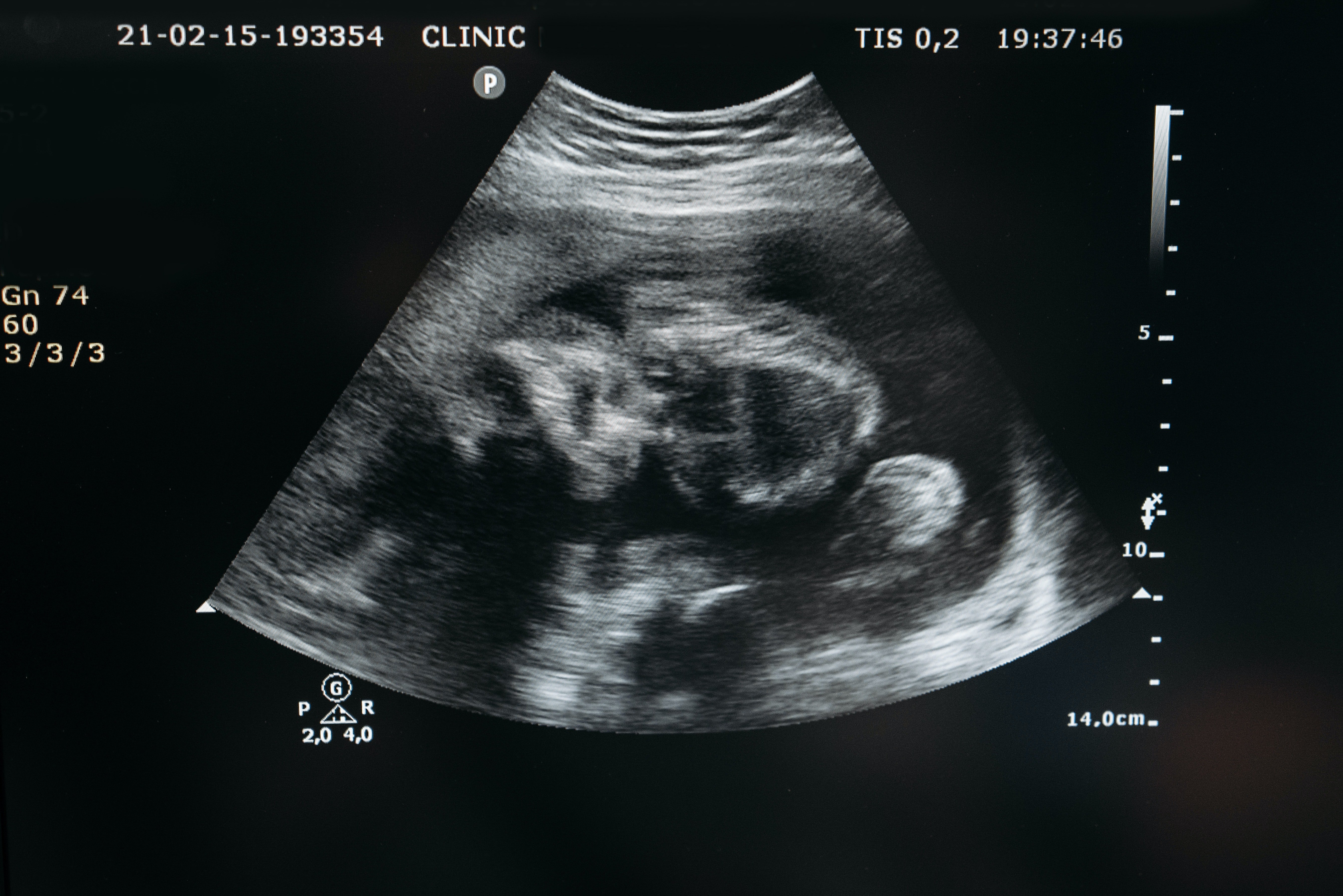 Ultrasonido de bebé en el vientre. | Foto: Pexels