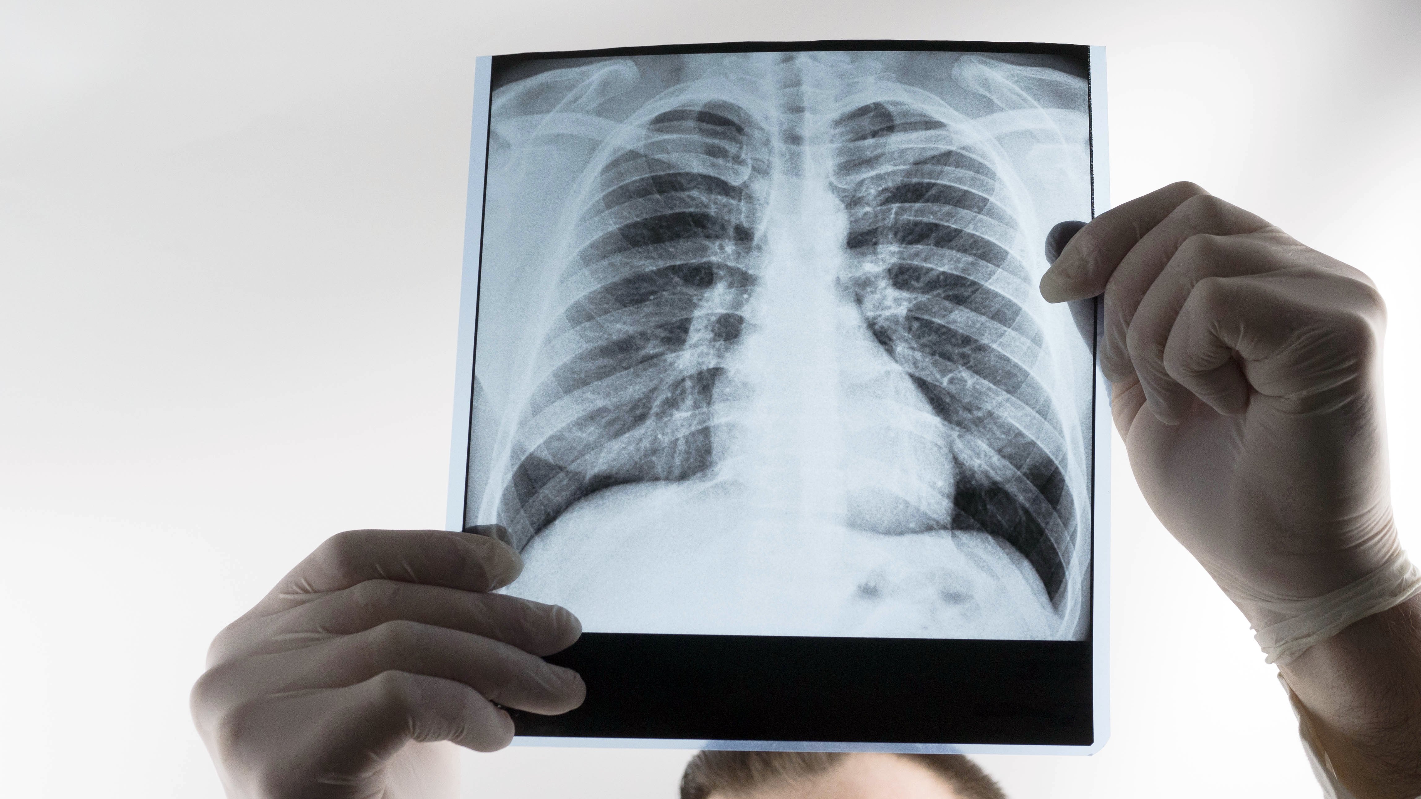A doctor holding up an x-ray of lungs.│Source: Shutterstock 