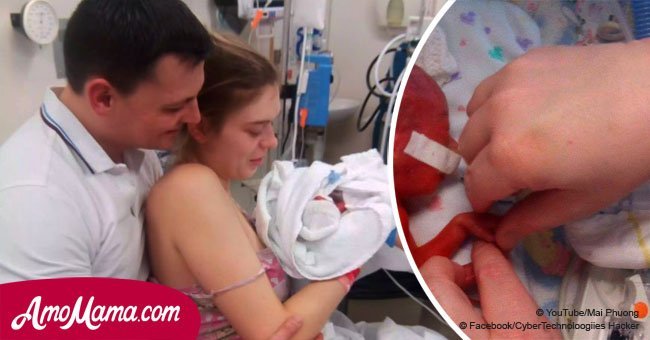 Newborn baby was born so premature that her parents could see her brain through her skin