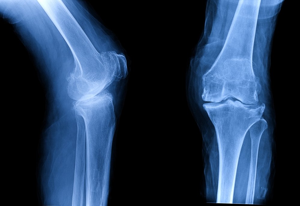 Radiografía de rodilla con osteoartritis. Fuente: Shutterstock