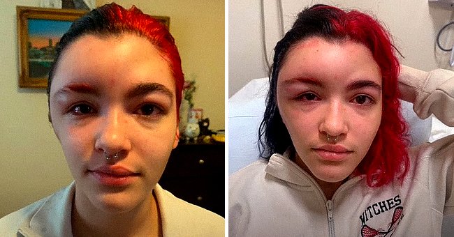 Seraya Ellison's allergic reaction to hair dye. │Source: tiktok.com/ser.gaya