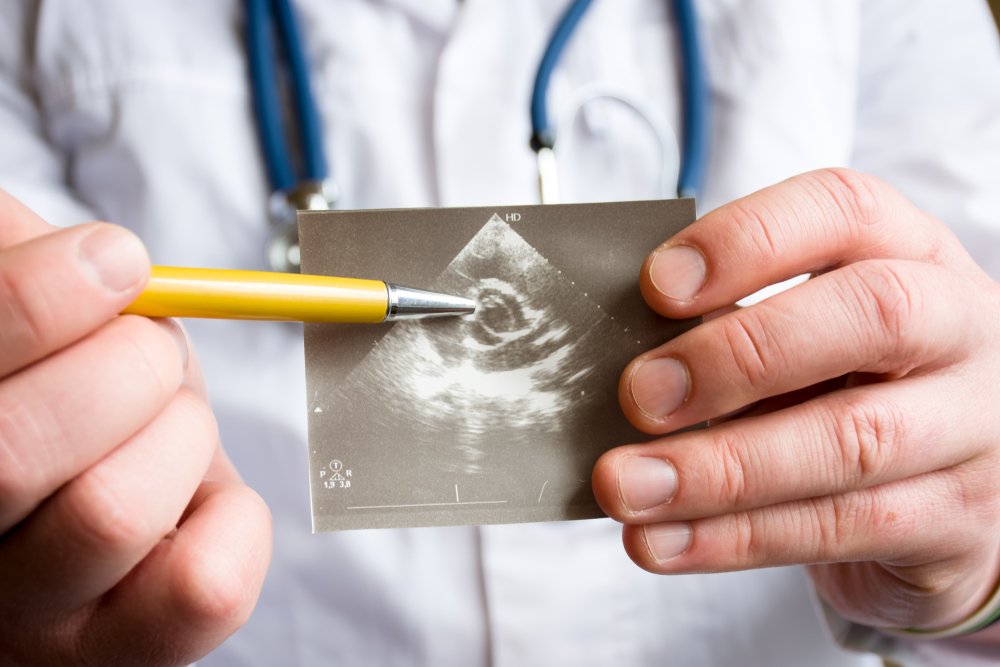 Doctor muestra defecto cardíaco en ecograma. || Fuente: Shutterstock Doctor muestra defecto cardíaco en ecograma. || Fuente: Shutterstock