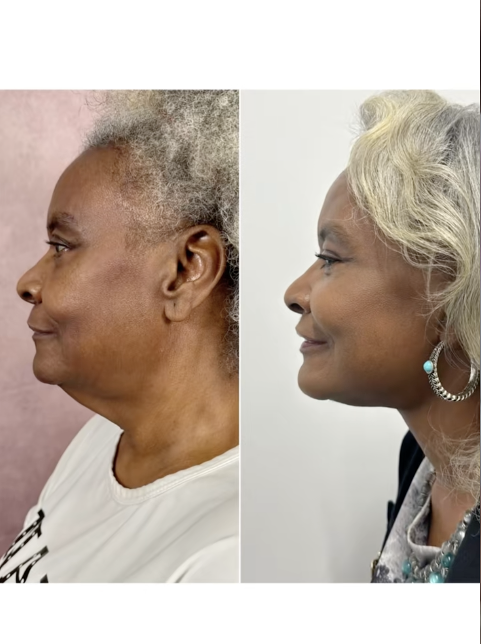 A screenshot of Linda Truesdale before and after getting a facelift from a post dated February 27, 2025. | Source: TikTok/doctor.truesdale
