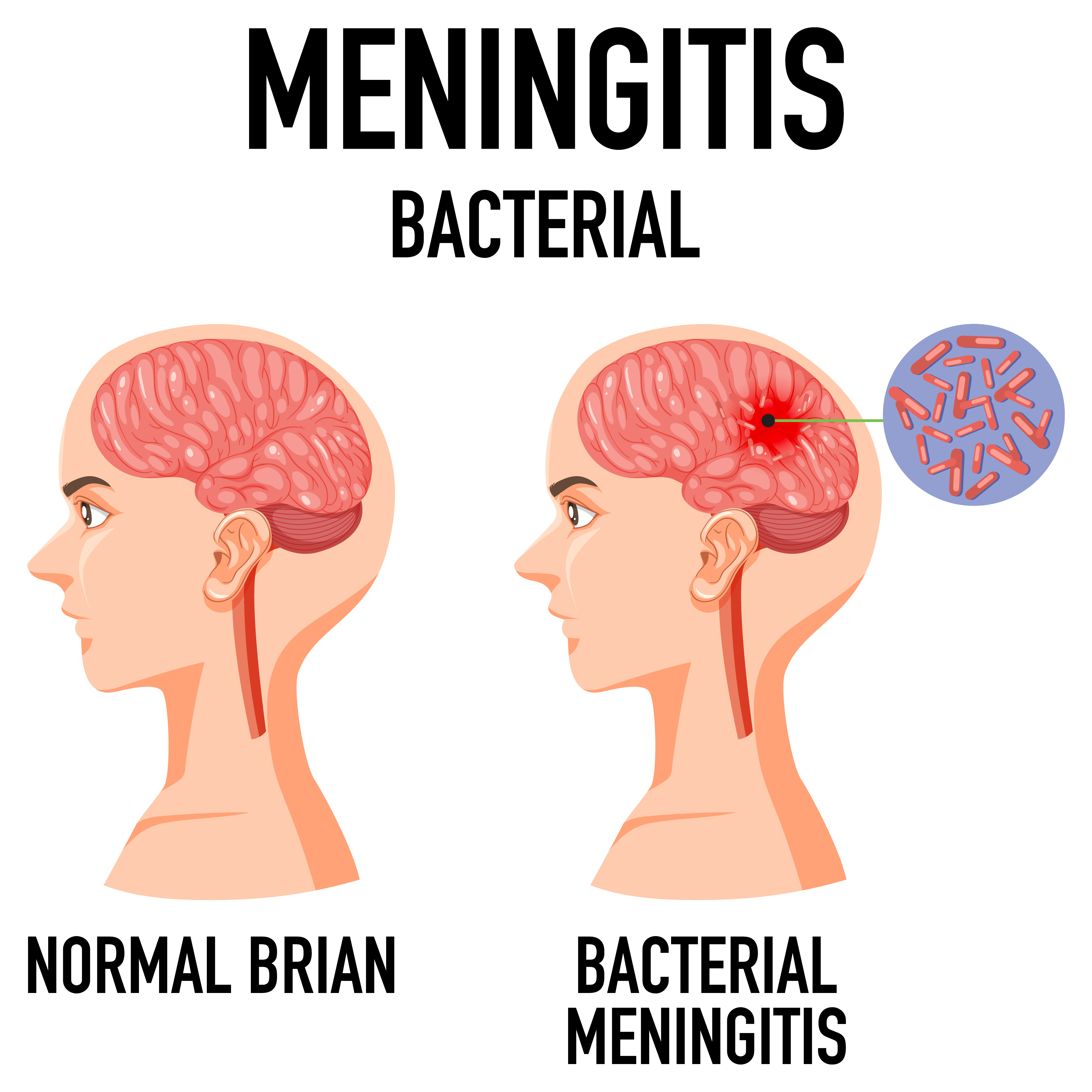 Diagram showing bacterial meningitis | Source: Getty images