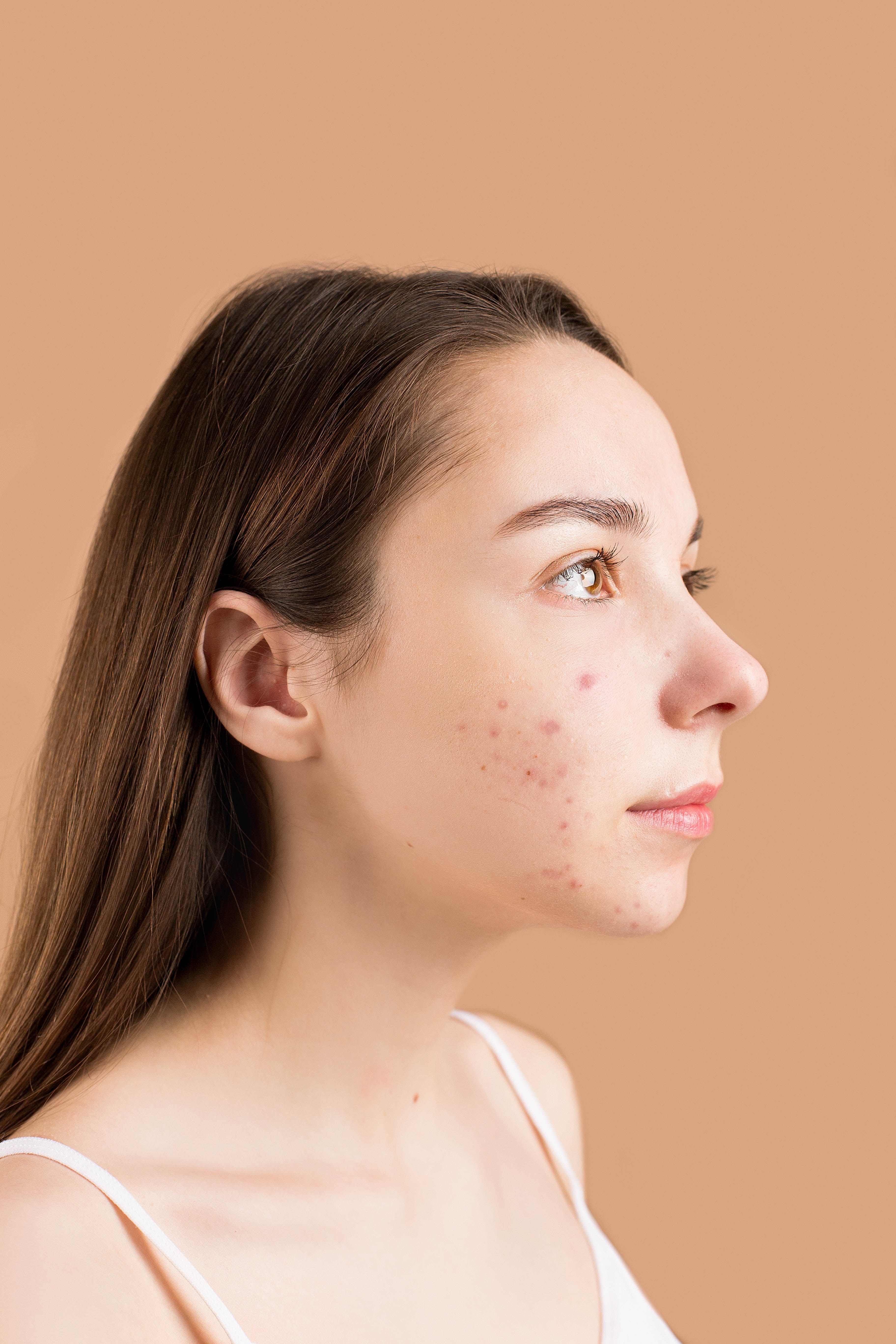 A woman with acne | Source: Pexels