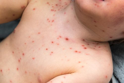 Young Child with Chickenpox. | Source: Shutterstock.