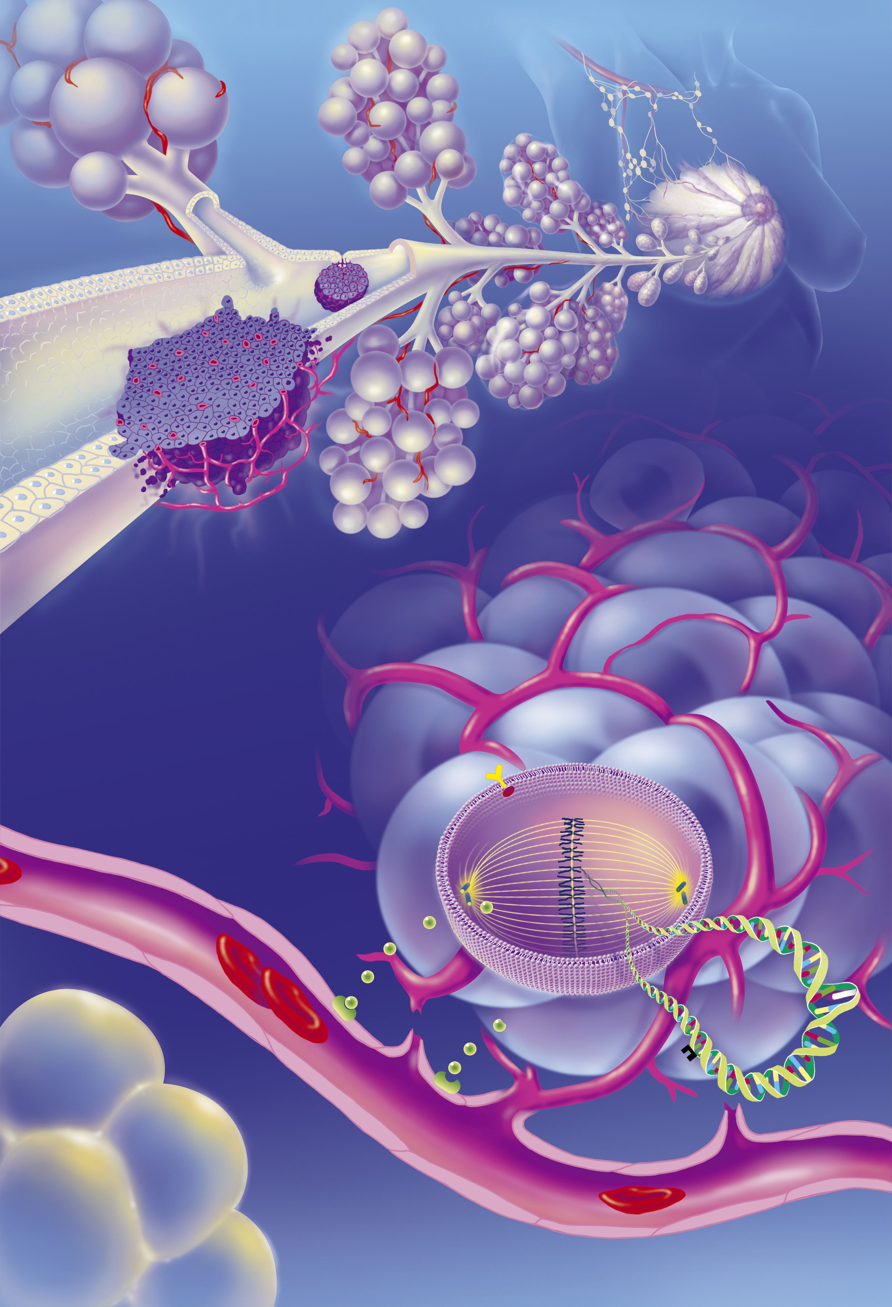 Medical illustration showing invasive and in situ ductal carcinomas. The image traces a zoom from the mammary gland to the milk duct, highlighting tumor locations, glandular structure, and axillary lymph nodes | Source: Getty Images