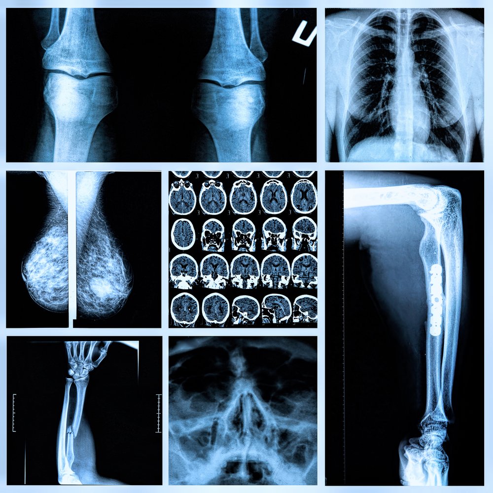 Radiographie osseuse. | Photo : Shutterstock Radiographie osseuse. | Photo : Shutterstock
