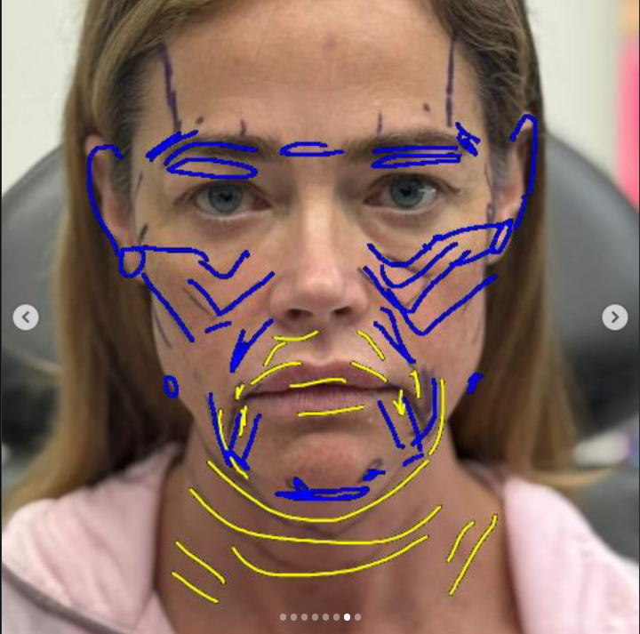 Markings on Denise Richards' face before the facelift | Source: Instagram/drbentalei | deniserichards