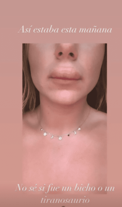 Ivana Icardi luciendo su inflamado labio luego de ser picada por un insecto. | Foto: Captura de Instagram/ivannaicardi