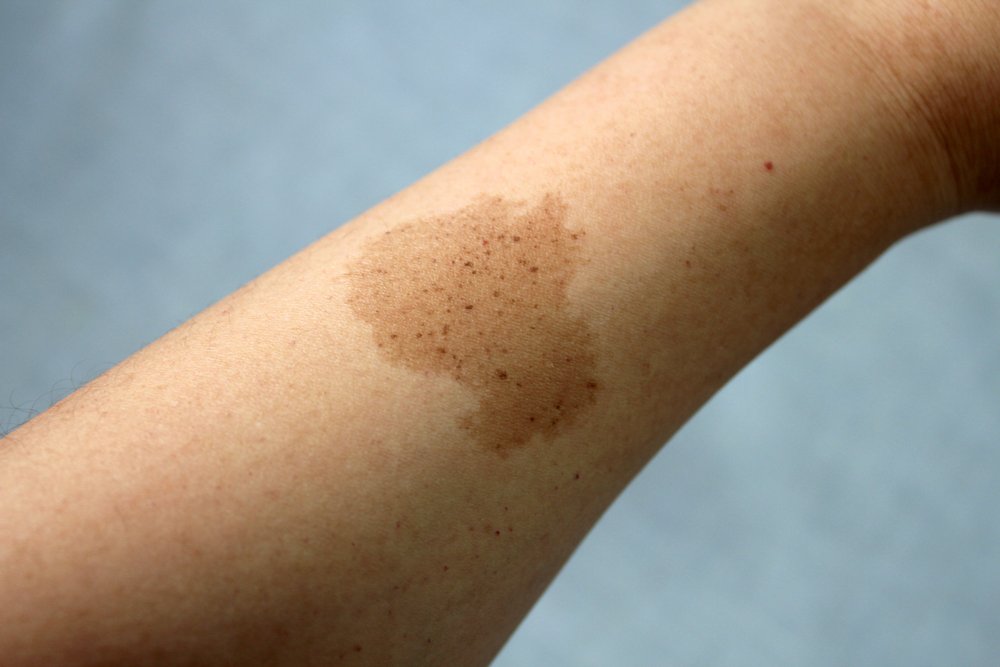 Mom recognized the birthmark on Ken's arm. | Source: Shutterstock