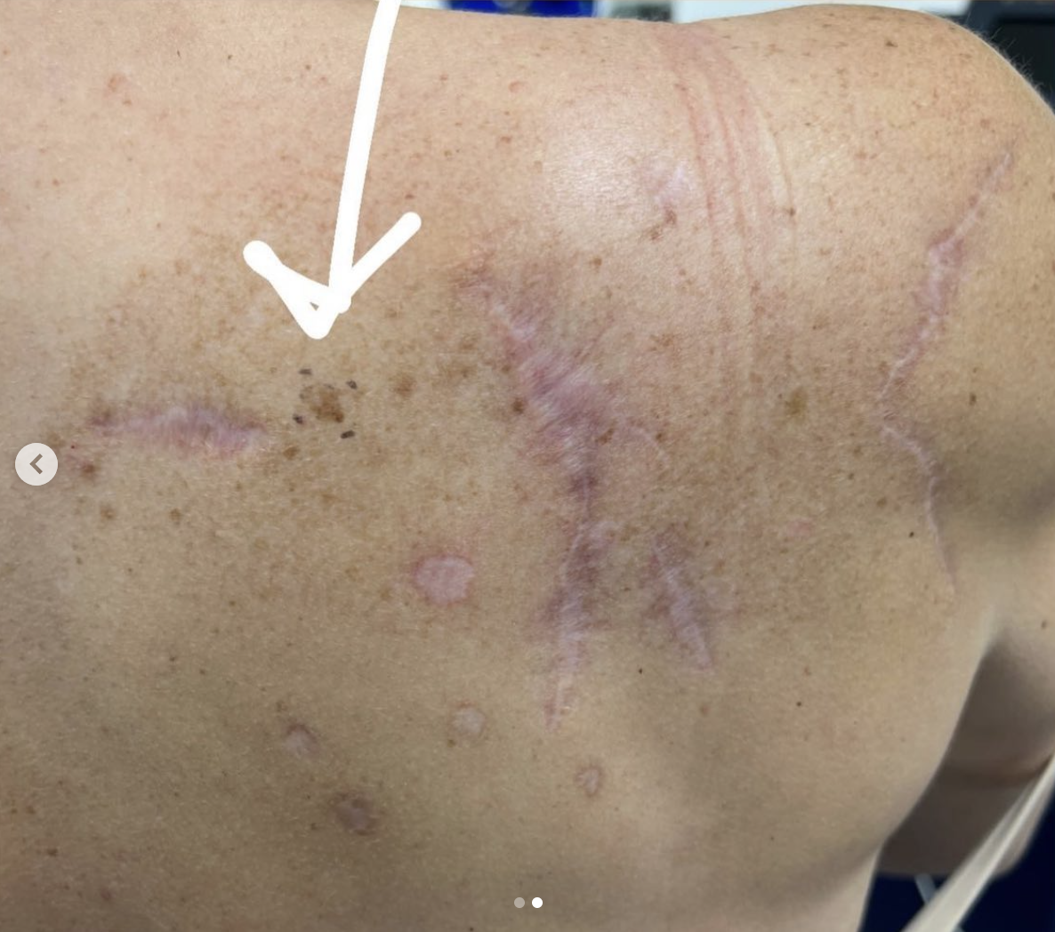 A closeup shot of Teddi Mellencamp's back showing a scar, as seen in a photo shared on September 13, 2023 | Source: Instagram/teddimellencamp