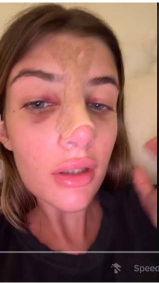 Sami Sheen shares her experience taking care of her nose post-surgery, on a TikTok post dated August 15, 2024 | Source: Tiktok/@samisheen