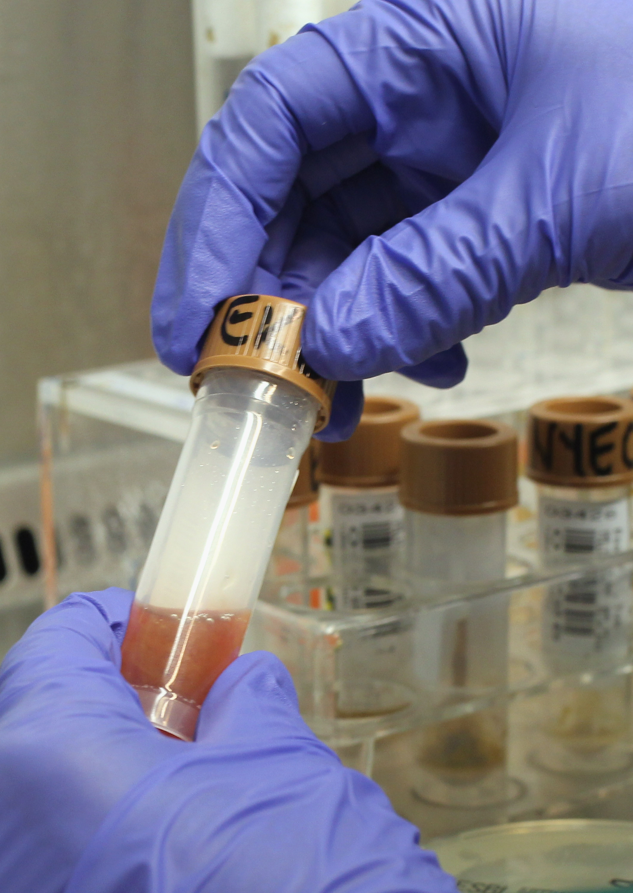 A lab technician opens a sample of bloodied stool taken from a patient | Source: Getty Images