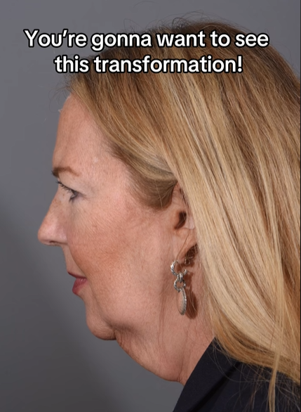 Picture of the woman before the precedure, dated July 11, 2023 | Source: TikTok/@quatela_center
