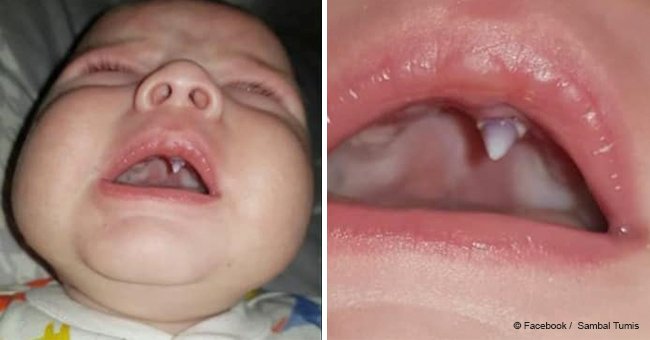 Parents and doctors horrified after baby grows a ‘fang’ overnight