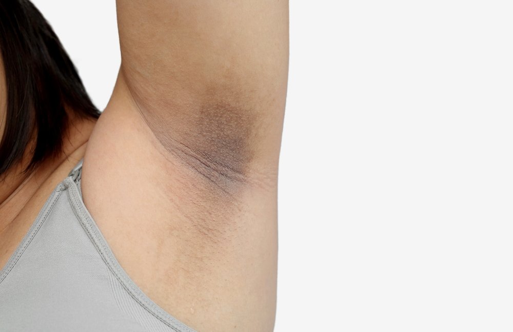 Hiperpigmentación de las axilas. | Foto: Shutterstock