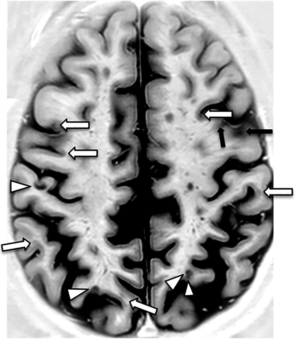 Resonancia magnética del cerebro. | Imagen: Wikimedia Commons