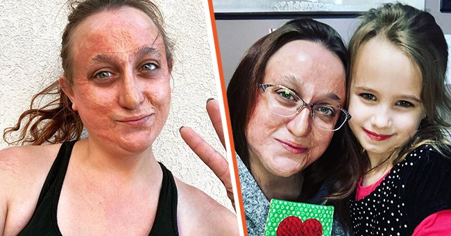 [Left] A burn victim who survived a devastating fire; [Right] A woman and her daughter who helped her on the road to acceptance. | Source: instagram.com/zylstrajoy