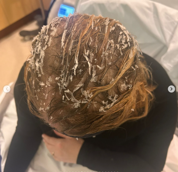 Morgan McGlynn Carr's hair during treatment, dated July 2, 2025 | Source: Instagram/morgancheeses