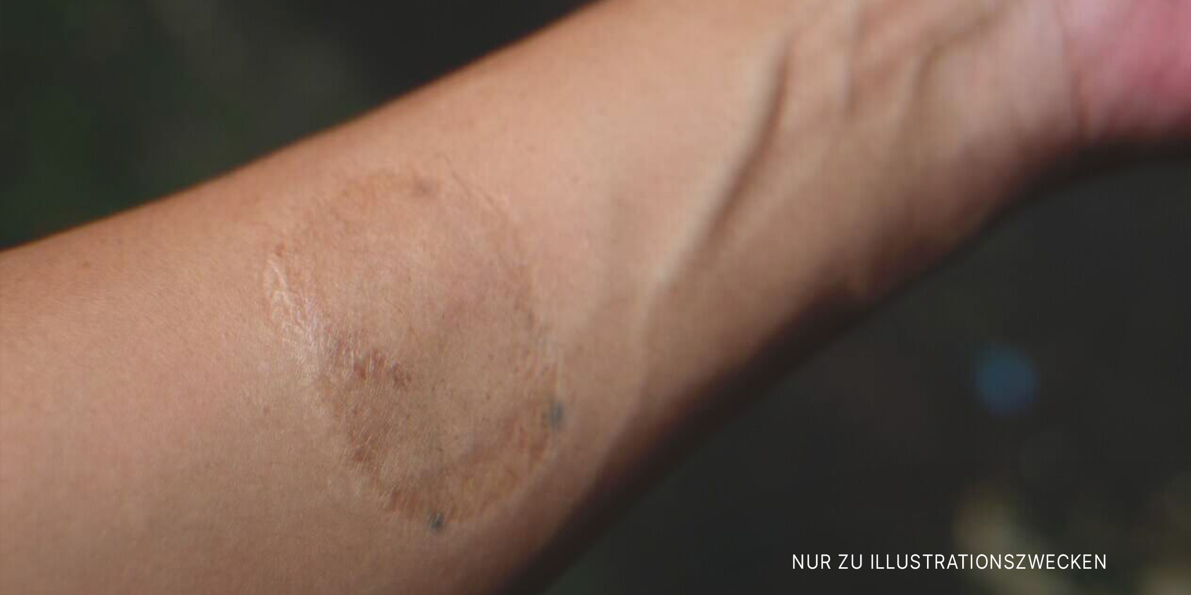 Narbe auf dem Arm einer Frau. | Quelle: Shutterstock