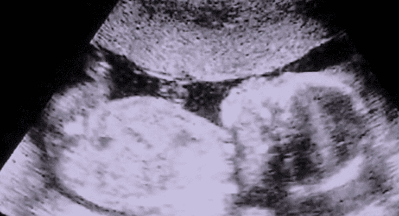 Ultrasound of the fetus.│Source: youtube.com/WXYZ-TV Detroit | Channel 7