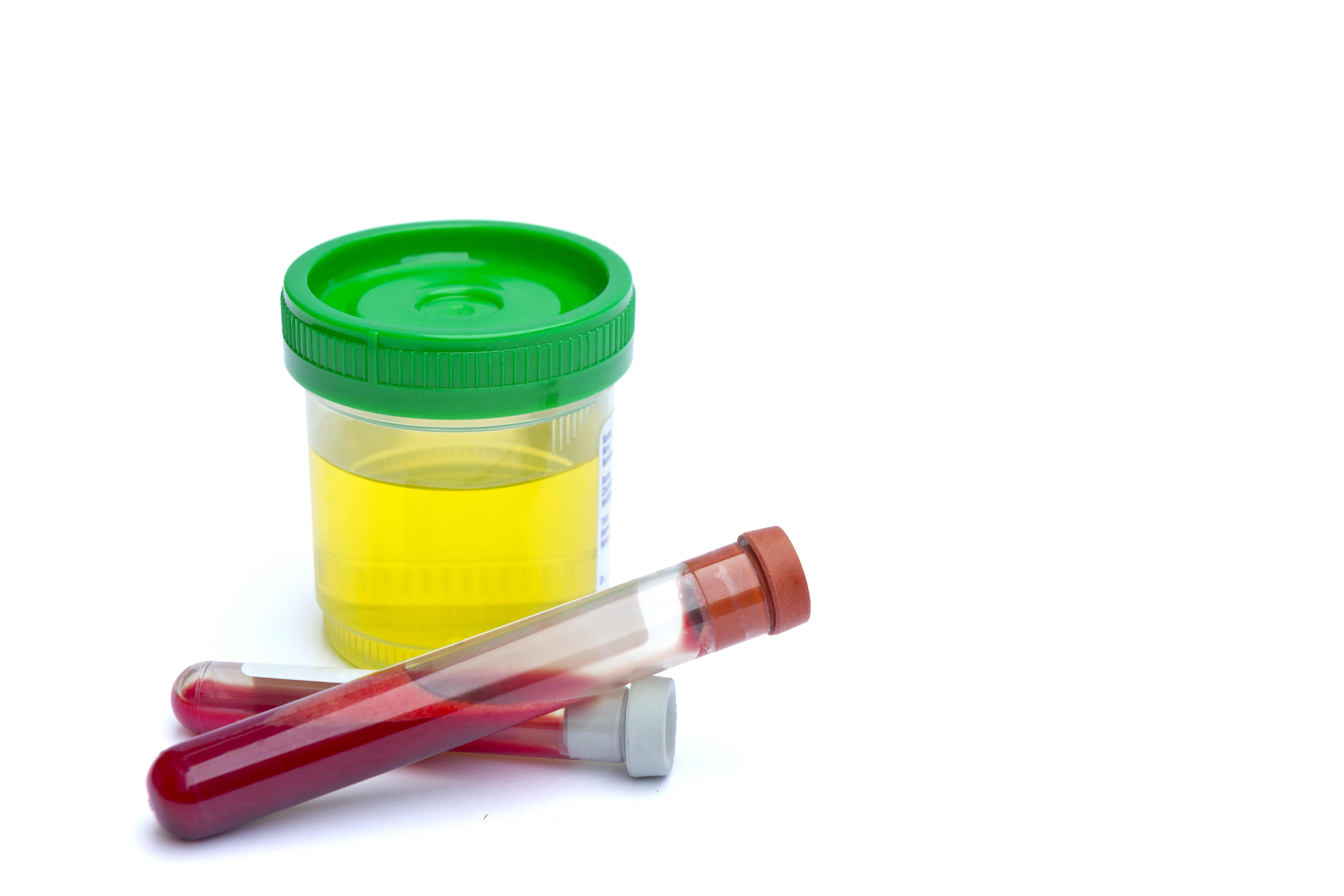 Sterile urine sample and blood test vials in a clinical setting | Source: Getty Images