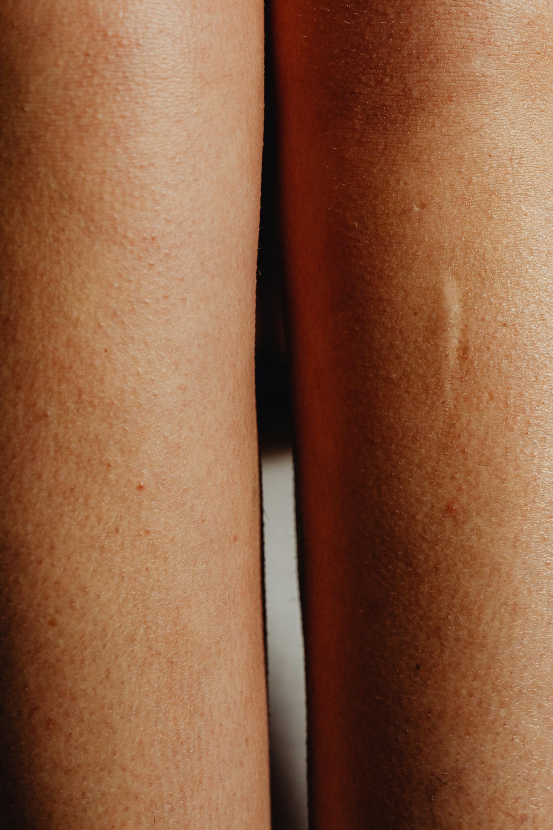 A closeup of a person's body with a scar | Source: Pexels