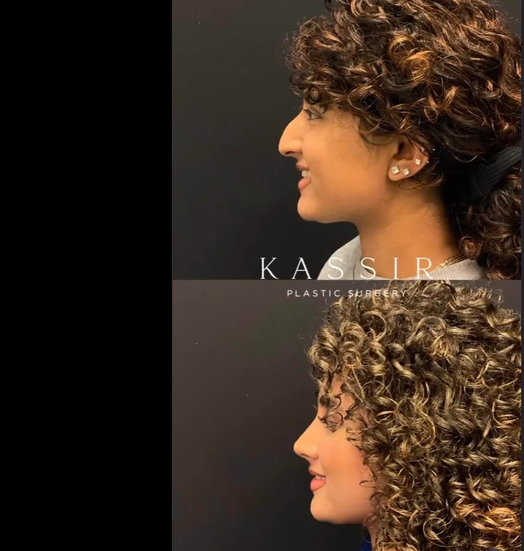 Photos of the patient before and after rhinoplasty, dated August 24, 2023 | Source: Instagram/drkassir