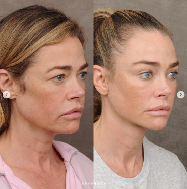 Denise Richards' before and after — Three-quarter (oblique) view | Source: Instagram/drbentalei | deniserichards