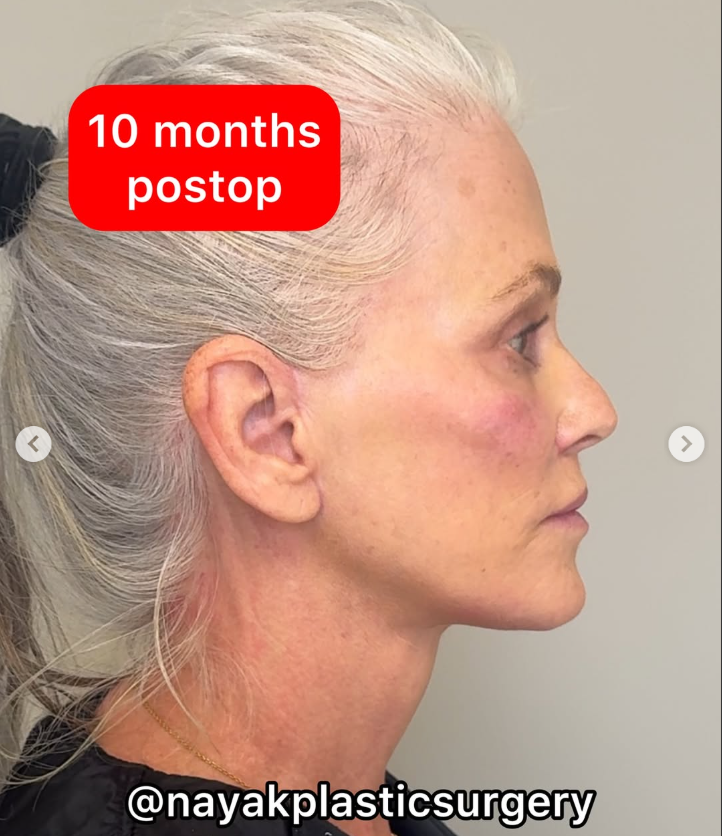 Lisa post-surgery, from a post dated April 4, 2025 | Source: Instagram/nayakplasticsurgery