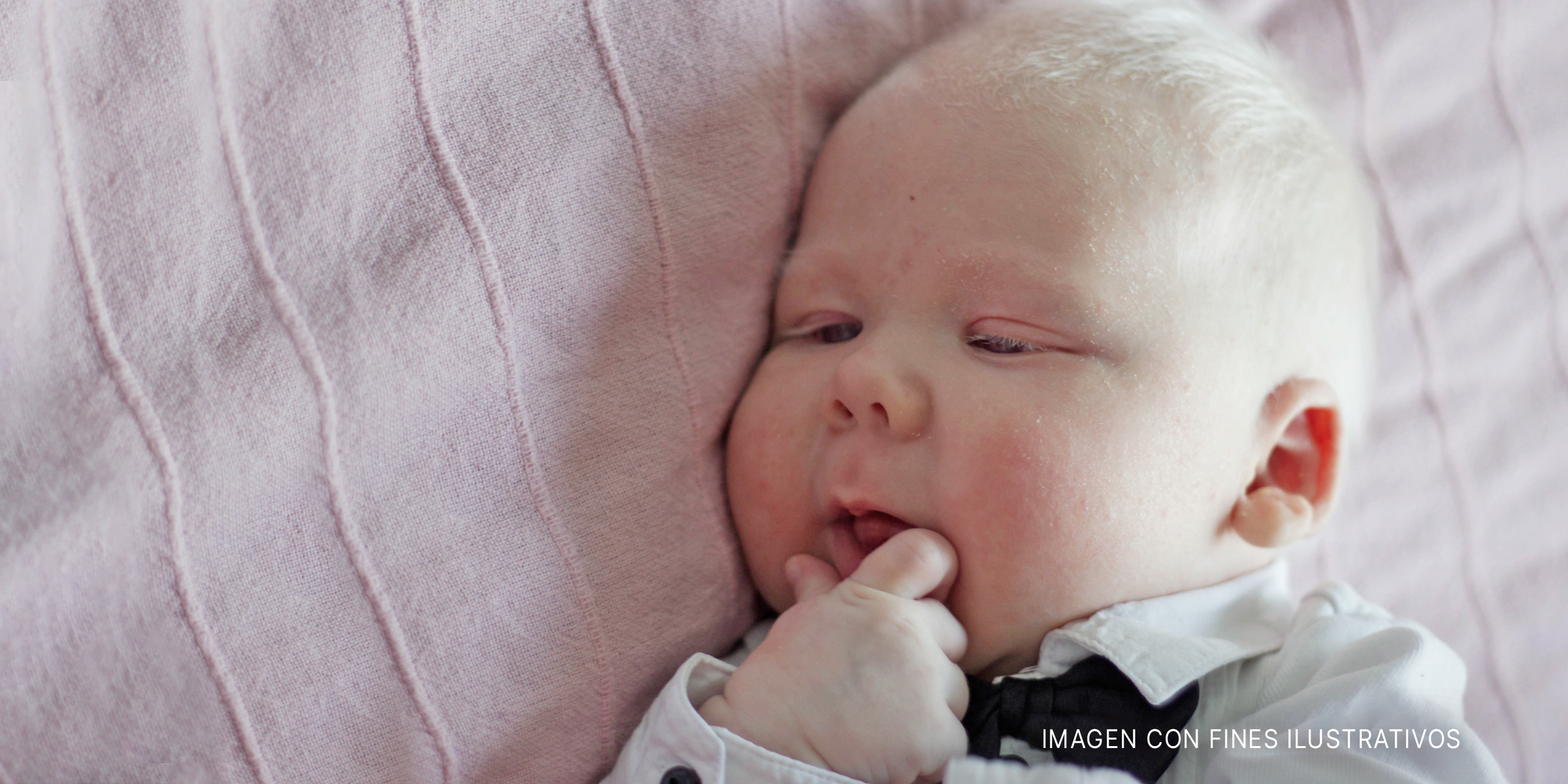 Bebé con albinismo | Foto: Shutterstock